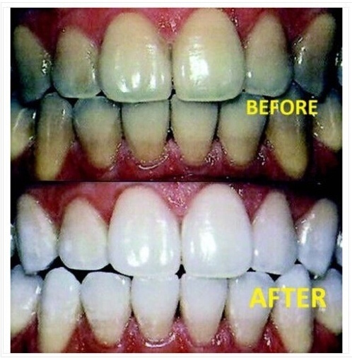 Safe Quick Teeth Set Home Use Teeth Whitening Bleaching Dental